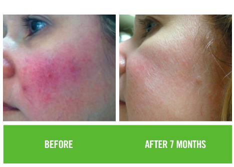 before & after 7 months